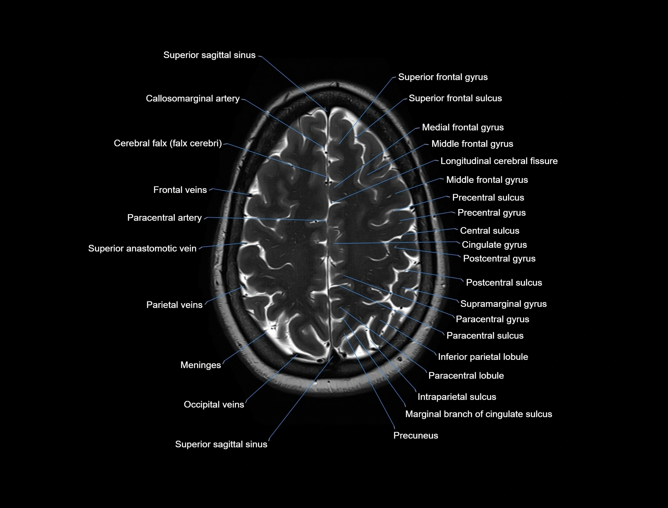 MRI Brain axial cross sectional radiology anatomy 3T image  -img-00001-00046.webp